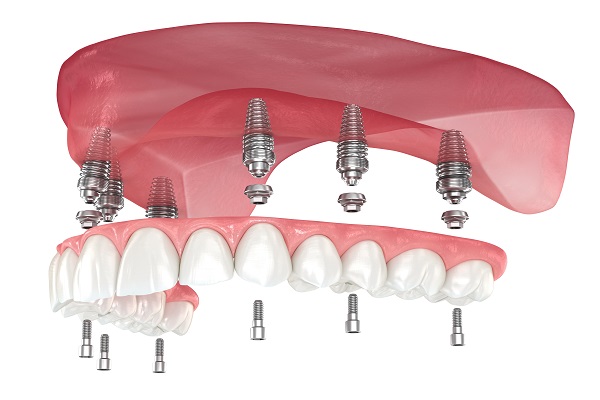 All-on-6 retained fixed dentures